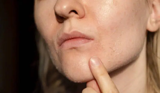Top Supplements to Combat Dry Skin and Keep Your Skin Hydrated