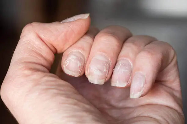 Vitamin B12 Deficiency Nails: Signs, Causes, and How to Fix It